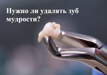 Удаление зуба мудрости Удаление зуба мудрости
