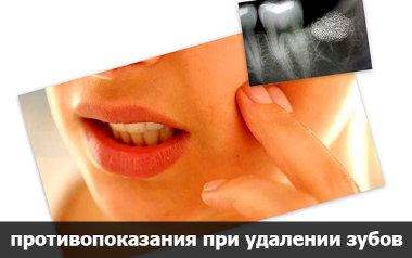 Удаление зуба Удаление зуба