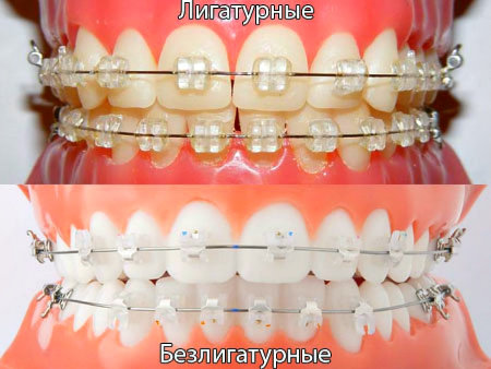 Лигатурные и безлигатурные брекет-системы Лигатурные и безлигатурные брекет-системы
