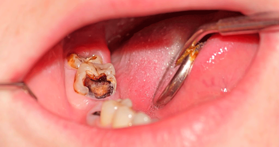 Клиновидный дефект зуба - причины, диагностика, симптомы